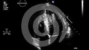 Ultrasound transesophageal examination of the heart.