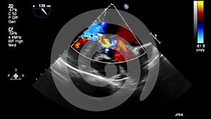 Ultrasound transesophageal examination of the heart.