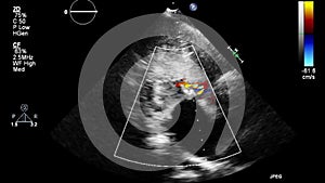 Ultrasound transesophageal examination of the heart.