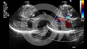 Ultrasound transesophageal examination of the heart.