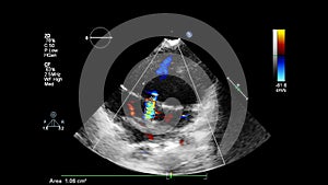 Ultrasound transesophageal examination of the heart.