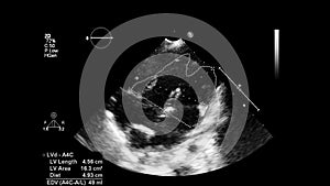 Ultrasound transesophageal examination of the heart.