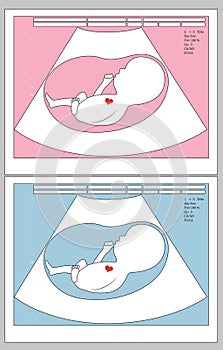 Ultrasound of unborn baby in mother`s womb, boy or girl, medical concept, vector illustration.