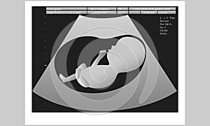 Ultrasound of unborn baby in mothers womb. Vector illustration