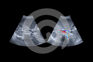 Ultrasound upper abdomen showing flow in common bile duct before and after use color Doppler.