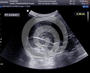 Ultrasound of urinary bladder or KUB.