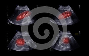 Ultrasound of urinary bladder  or KUB for  screening  renal and bladder disease