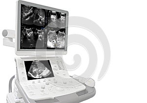 Ultrasound whole abdomen showing body and antrum with luminal narrowing of gastic antrum.Liver,GB,CBD,pancreas,spleen and both photo