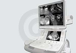 ultrasound whole abdomen showing body and antrum with luminal narrowing of gastic antrum.Liver,GB,CBD,pancreas,spleen and both photo