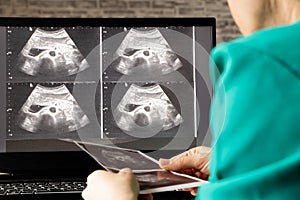 Ultrasound of a woman& x27;s abdomen on a laptop screen monitor in a doctor& x27;s office, diagnostics of an abdominal pain