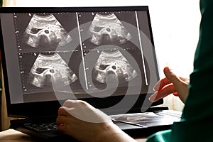 Ultrasound of a woman's abdomen on a laptop screen monitor in a doctor's office, diagnostics of an abdominal pain