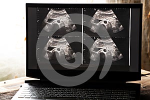 Ultrasound of a woman's abdomen on a laptop screen monitor in a doctor's office, diagnostics of an abdominal pain