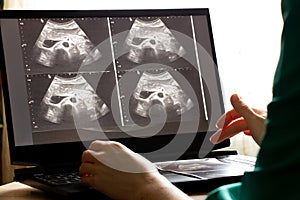Ultrasound of a woman`s abdomen on a laptop screen monitor in a doctor`s office, diagnostics of an abdominal pain