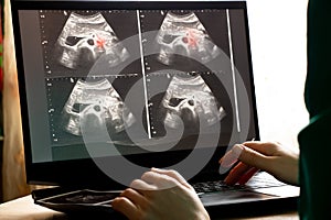 Ultrasound of a woman`s abdomen on a laptop screen monitor in a doctor`s office, diagnostics of an abdominal pain