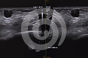 Ultrasonography of breast nodule. photo