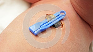 Umbilical clamp baby