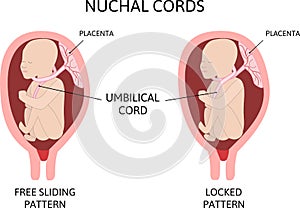 Umbilical Cord around Neck. Nuchal cord. two loopes is on the child`s neck