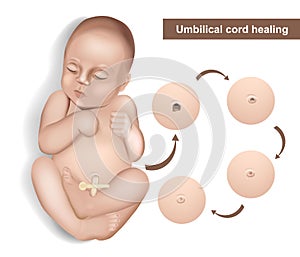 Umbilical cord care in newborns. Newborn umbilical cord stump falling off cycle. Dried stump of an umbilical cord of a