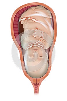 Umbilical cord entanglement in pregnancy. Umbilical Cord compression around neck. Illustration Nuchal Cord