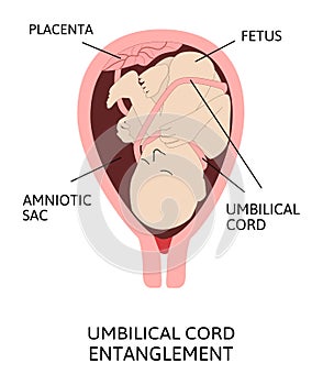 Umbilical cord entanglement. vector illustration of entanglement of umbilical cord around the fetus.