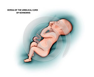 Umbilical cord Hernia in a newborn