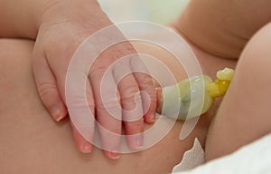 An umbilical cord in a newborn