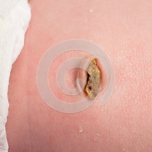 Umbilical cord stump in a newborn's navel