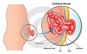 Umbilical hernia