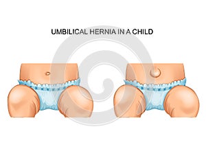 Umbilical hernia in a child