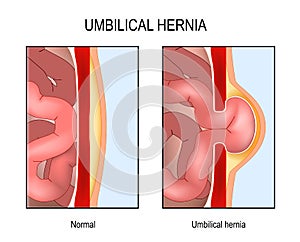 Umbilical hernia. Cross section of abdomen with small intestine