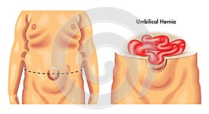 Umbilical hernia