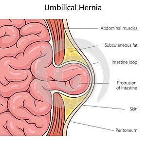 Umbilical hernia structure diagram medical science