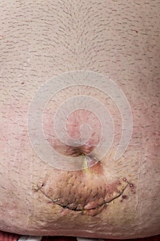 Umbilical hernia wound