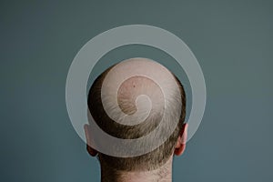 Unadorned Baldness head problem. Generate ai