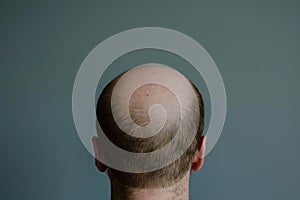 Unadorned Baldness head problem. Generate ai photo