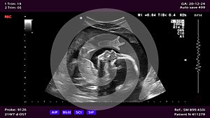 Unborn baby does Dio's two-finger gesture in the womb.