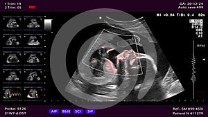Unborn baby gives Thumbs Up from the womb.