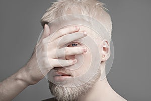 Uncommon albino guy closing his face with palm, looking with one eye through fingers at camera, grey studio background