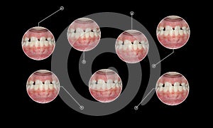 Under bite malocclusion orthodontic graphic elements