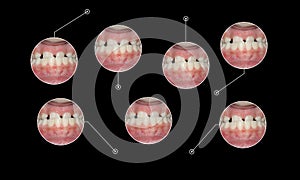 Under bite malocclusion orthodontic graphic elements photo