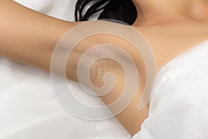 Underarm girl client after laser hair removal photo