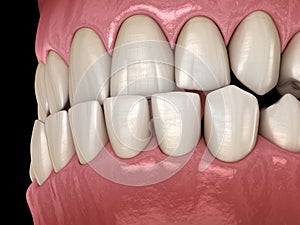 Underbite dental occlusion  Malocclusion of teeth . Medically accurate tooth illustration