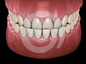 Underbite dental occlusion  Malocclusion of teeth . Medically accurate tooth illustration photo