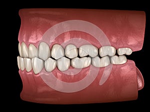 Underbite dental occlusion  Malocclusion of teeth . Medically accurate tooth 3D illustration photo