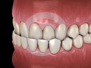 Underbite dental occlusion  Malocclusion of teeth . Medically accurate tooth 3D illustration