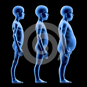 Undernourished child, with normal build and obese child in comparison photo
