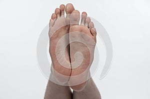 Underside of caucasian young man`s naked bare tired feet with dry, flaking skin,  on white