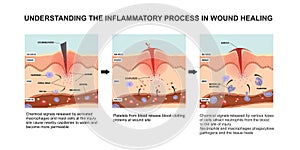 Understanding the inflammatory process in wound healing photo
