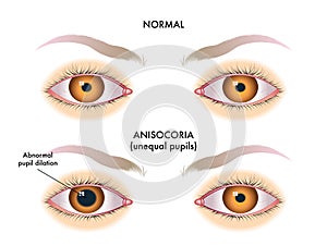 Unequal pupils medical illustration