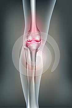 Unhealthy Human leg joint